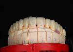 Natural Looking Zirconia Tooth Crown Stain Resistance All Zirconia Crown