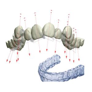 China Retainer Braces FDA Fixed Orthodontic Appliance With 3D factory