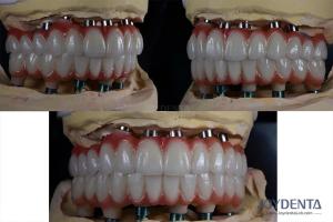 China 10mm Titanium Multiple Teeth Implant Rough Surface For Dental Restoration factory