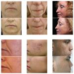 Nubway fractional rf / microneedle rf / wrinkle removal machine