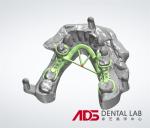 Concealed Metal Cast Frame Partial Denture Framework Partial Full Arch