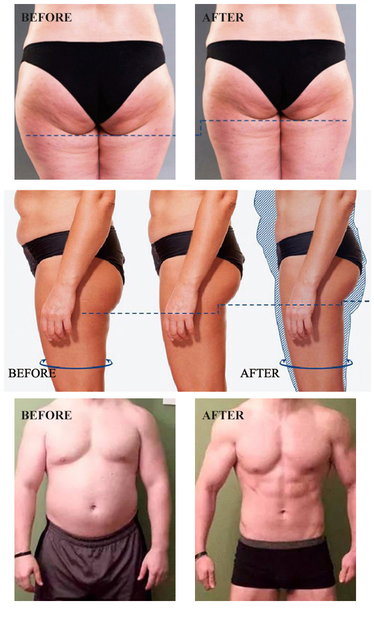 EMT-8 Abdominal Build EMS Muscle Stimulator Machine , Slimming RF Cavitation Machine