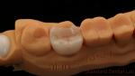 Translucency Dental Zirconia Crown Inlay Onlay Crown For Restore Natural Cavity