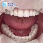 Nature Design Dental Implant Case Implant Operation Cases For Multiple Choices