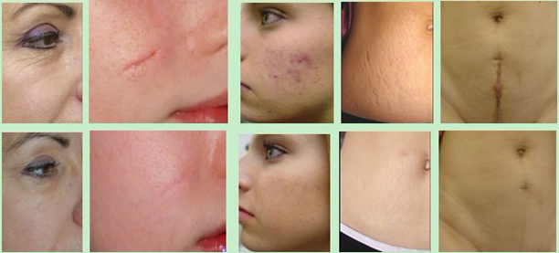 protbale CO2 Fractional Laser beauty machine with CE