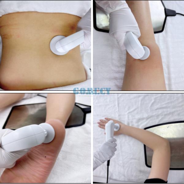 RF Therapy Machine, Pain Relief, Muscle Recovery, Skin Tightening, Cellulite Reduction