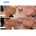 1470nm 980nm 6 + 1 Diode Laser Therapy Device Fiber-Coupled Laser For Vascular