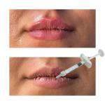 Injectable Hyaluronic Acid Dermal Filler Lip Enhancement Fillers