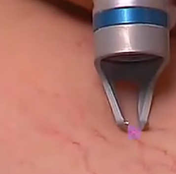 980nm medical diode laser spider vein removal machine/980nm laser vascular vein removal