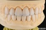 0.3-0.5mm Thick Feldspathic Porcelain Veneer High Fracture Resistance Upgrade