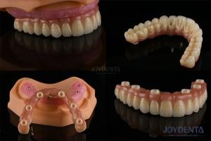 China Dental Multiple Teeth Replacement Implants Rough Surface Prosthetic Components factory