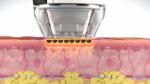 Microneedling RF Fractional Radio Frequency Beauty Equipment Facelift Skin Tight