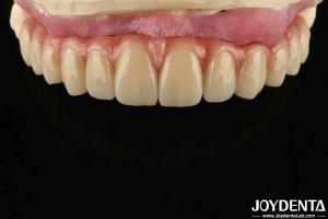 China Comfortable Wear Titanium Malong Hybrid Bridge Dental Adjustable Design Light Weight factory