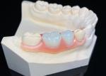 OEM Invisible Removable Dentures Custom Acrylic Resin Partial Dental Prosthesis