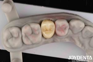 China Fracture Toughness 9 MPa·m1/2 High Aesthetics High Resistance To Wear Full Zirconia factory