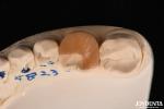 Zirconia Inlay Onlay With Adhesive Cementation For Damaged Teeth Restoration