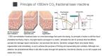 1550nm Er Yag Laser Machine Erbium Glass Fractional Laser Resurfacing Machine