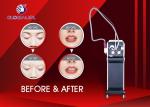 Yag Laser Q - Switch IPL RF Beauty Equipment For Tattoo And Birth Mark Removal