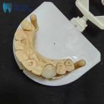 Corrosion Resistant Zirconia Crowns Natural Looking Zirconia Teeth