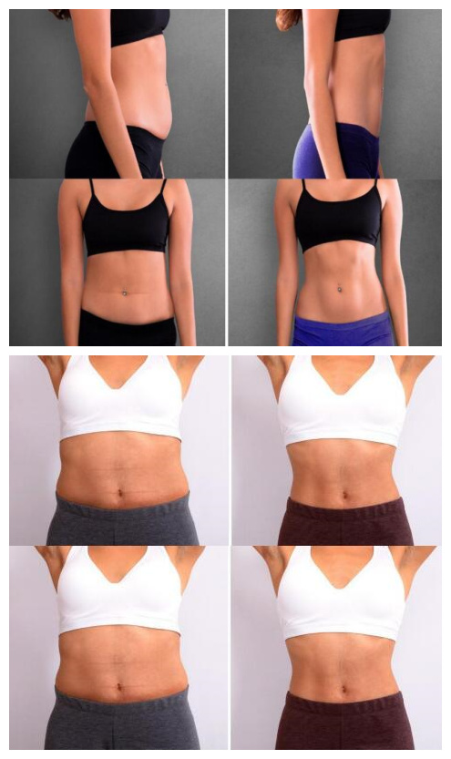 Hiemt Ems Body Contouring Machine For Cellulite Reduction