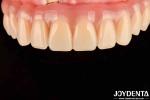Dental Treatment High Elasticity Acrylic False Teeth Finish For Tooth Arrangemen