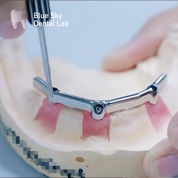 Resin Teeth Dental Titanium Bar Removable Blue Sky Implant System
