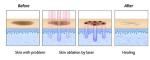 Multifunctional 4D Fotona CO2 Fractional Laser Machine Wrinkle Removal
