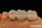 High Strength Dental Zirconia Your Ultimate Solution For Natural-looking