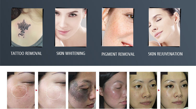 350MJ 600MJ Q Switched ND YAG Laser Machine 1320 Nm Birthmark Nevus Removal
