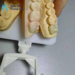 Corrosion Resistant Zirconia Crowns Natural Looking Zirconia Teeth