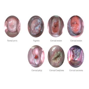 16M Memory Digital Vaginal Endoscopic Electronic Colposcope with 1.5 Magnificati