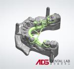 Concealed Metal Cast Frame Partial Denture Framework Partial Full Arch