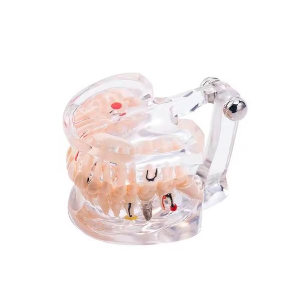 32 Tooth Full Month Implant Disease Teeth Model Clear Design Dental Pathology