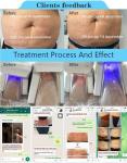 2018 China manufacturer four cryolipolysis machine for sale/criolipolisis