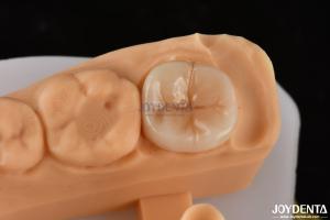 China 0.5mm-2mm Precise Fit Emax Dental Inlay Onlay For Reliable Tooth Restoration factory