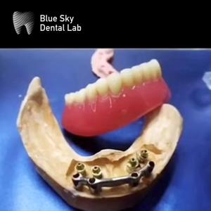China Full Mouth Dental Titanium Bar Accurate Removable Denture Restoration factory