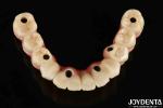 Aesthetic Titanium Malong Hybrid Dental Implant Bridge For Dental Perfection