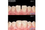 Secure Fit Porcelain Veneers Dental Treatment Composite Resin Veneers Stain