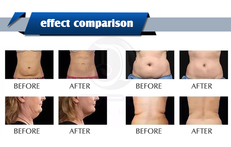 AS83 RF Vacuum Cavitation System , Ultrasonic Body Slimming Vacuum Machine