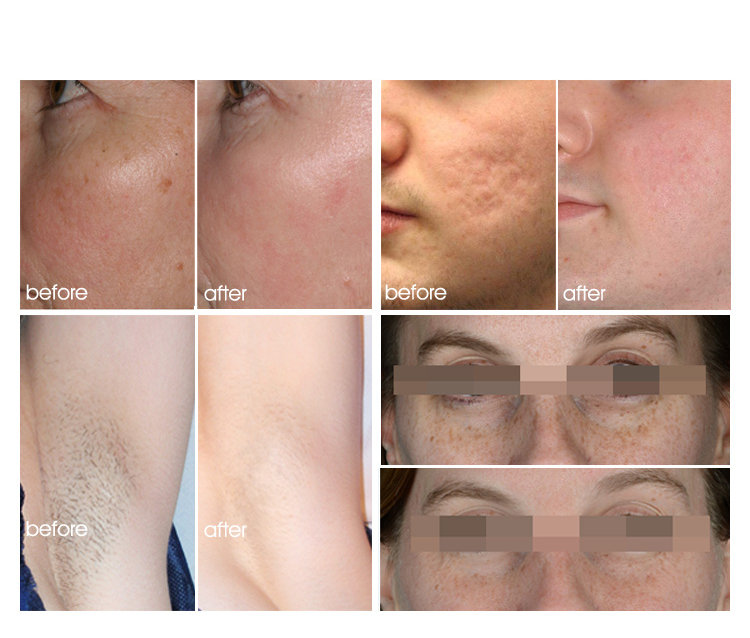 Professional IPL Laser Hair Removal Machines For Salon​ 2 Years Warranty