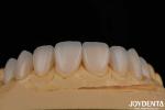 Highly Translucent Glass Porcelain Teeth Veneers High Strength 0.3-0.8mm