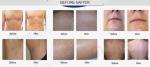 808nm diode laser epilation desktop machine with permanent hair removal laser