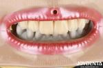 Layered Zirconia High Aesthetics Excellent Biocompatibility Sintering Temperatur