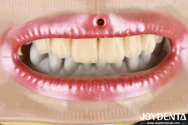 Layered Zirconia High Aesthetics Excellent Biocompatibility Sintering Temperatur