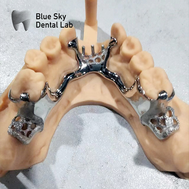 Blue Sky Dental Framework Partial Maxillary Denture Cast Metal Framework