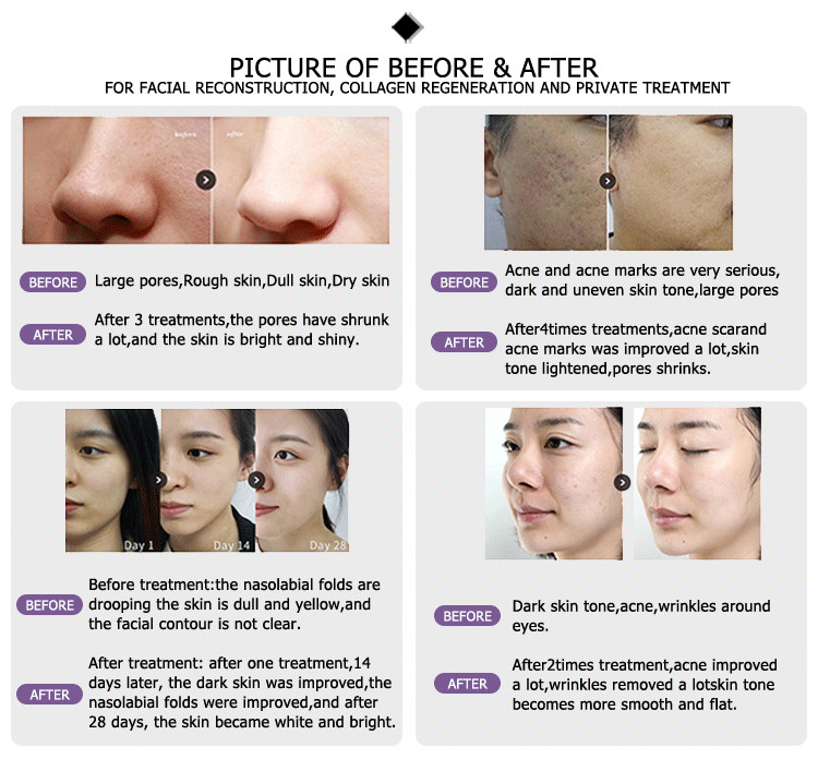 Professional 2021 newest 1-100ms pulse duration 30w fractional co2 laser treatment for acne scars