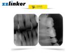 Medical 30KHz 0.1MA 60KV RVG Dental X Ray Machine
