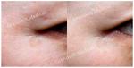 Face Lift PCL Dermal Filler Skin Care Lifting Tightening Stimulating Collagen