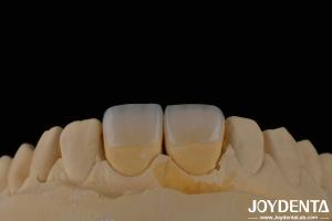 China Long Lasting Dental Feldspathic Veneer Natural Tooth Color Translucent Appearance factory