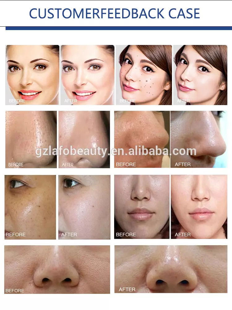 Best selling multifunction facial care microdermabrasion machine for sale